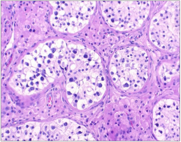 Histologisches Bild einer Keimzellneoplasie in situ