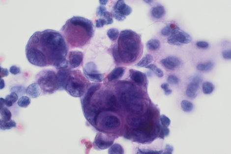 Tumorzellen eines colorektalen Karzinoms in einem Höhlenergusspunktat (Aszites)