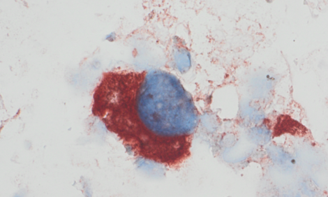 Immunzytochemische Darstellung von HMB45 in einer Metastase eines malignen Melanoms ("schwarzer Hautkrebs") in einem Lymphknotenpunktat
