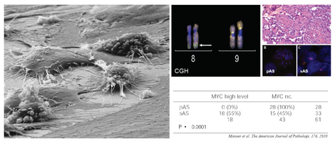(Links): Rasterelektronische Aufnahme eines Angiosarkoms in Zellkultur. (Rechts): Histologie und molekulargenetische Analyse (FISH) von primären und strahleninduzierten Angiosarkomen. Strahleninduzierte Angiosarkome weisen in einem hohen Prozentsatz high-level-Amplifikationen des Oncogens c-MYC auf. (Manner et al. Am J Pathol 2011)