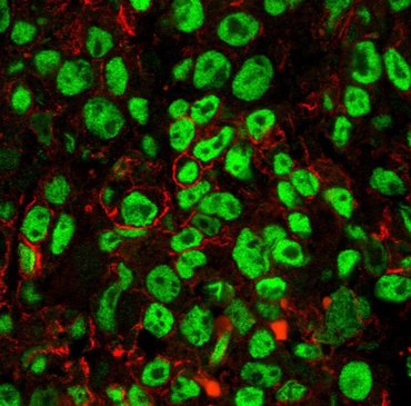 Immunhistochemische Färbung vom Endothelzellmarkern CD31 (rot) und ERG (grün) im Angiosarkom (Modifiziert von Venkataramani et al., 2018b)
