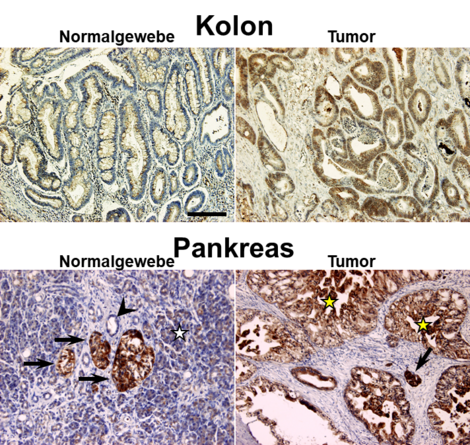 Immunhistochemische Färbung vom Alzheimer Protein APP im Kolon- und Pankreaskarzinom verglichen zum entsprechenden Normalgewebe (Modifiziert von Venkataramani et al., 2010)